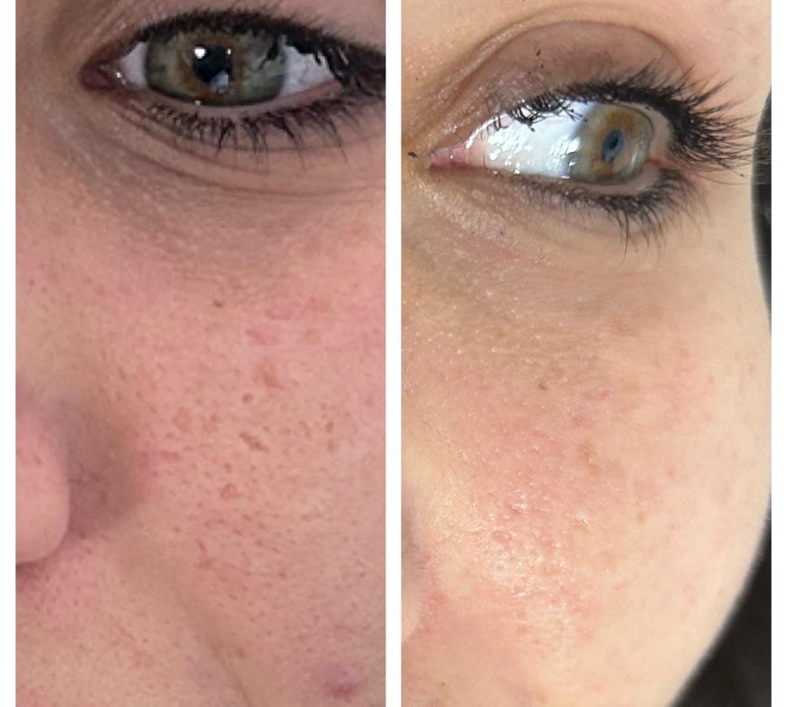 medicina estetica, estetica, medicina, nardo, lecce, trattamento, occhiaie, botox, botulino, micro botox, viso, collo, mani, biorivitalizzazione, fili, seno, filler, labbra, zigomi, vivace, laser, rughe, pelle, medico, clinica, poliambulatorio, salento, puglia, macchie, rimozione, cisti, fibromi, codice a barre, volto, mani, alopecia, prp, blefaroplastica, intralipoterapia, mesoterapia, grasso, eliminazione grasso, lifting, nuova vita