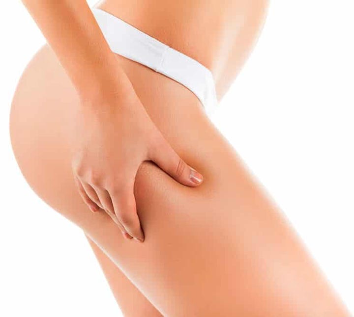 rimozione cellulite, carbossi terapia